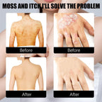 Herbal Psoriasis Relief Spray (Pack Of 2)